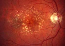 DMRI, degeneracao macular relacionada a idade